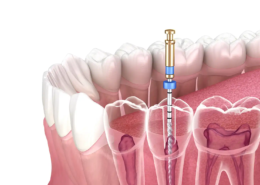 Endodonzia 4 Endodonzia