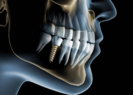 Implantologia dentale 6 implantologia