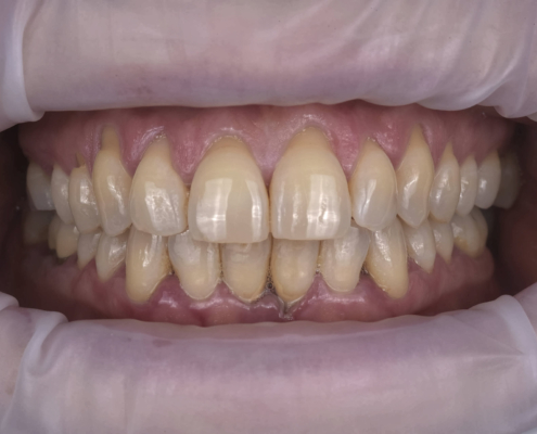 parodontite dentista